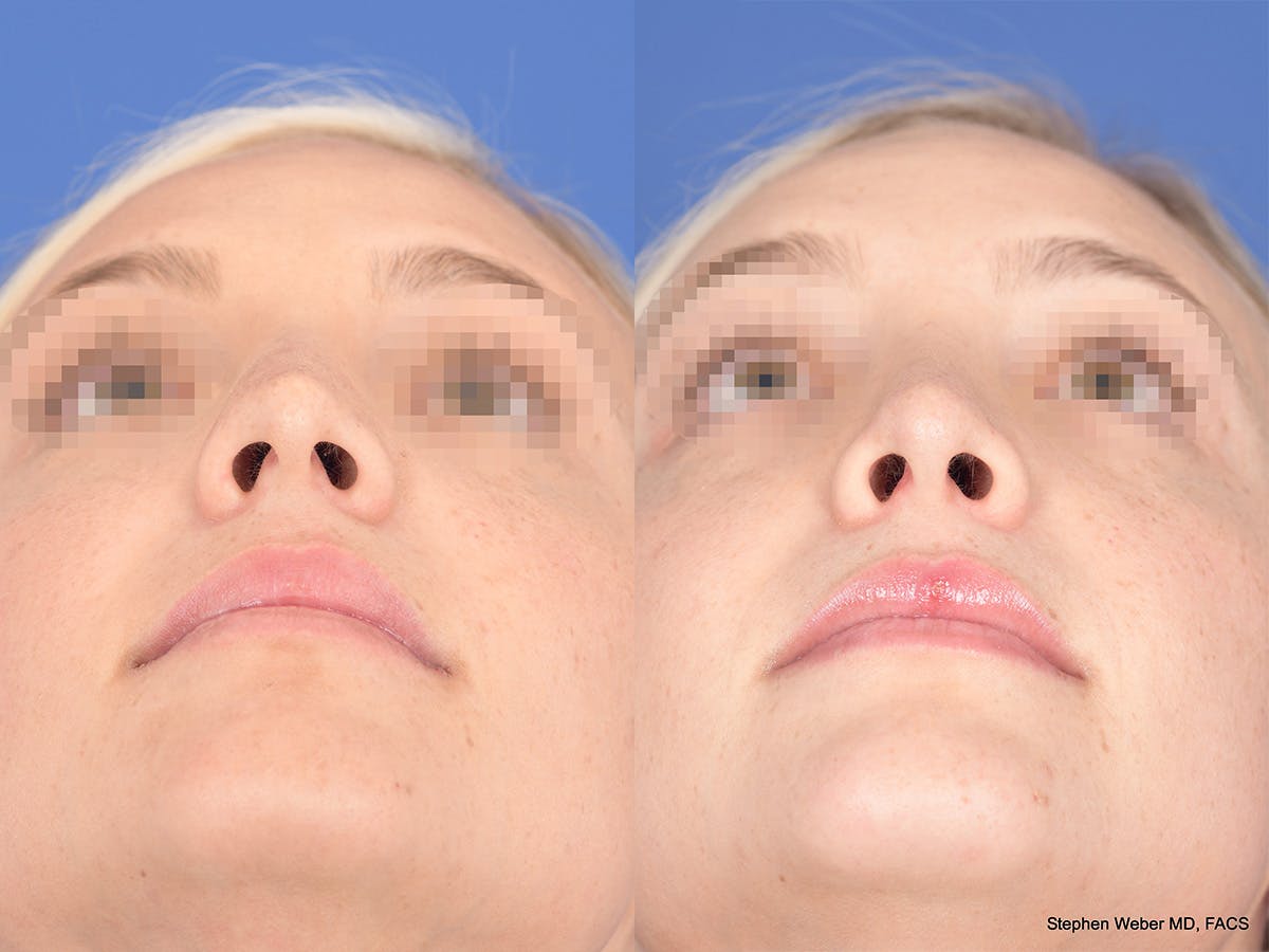 Rhinoplasty Before & After Gallery - Patient 429210 - Image 5