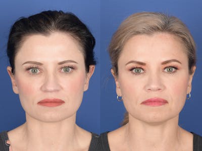 Rhinoplasty Before & After Gallery - Patient 677841 - Image 1