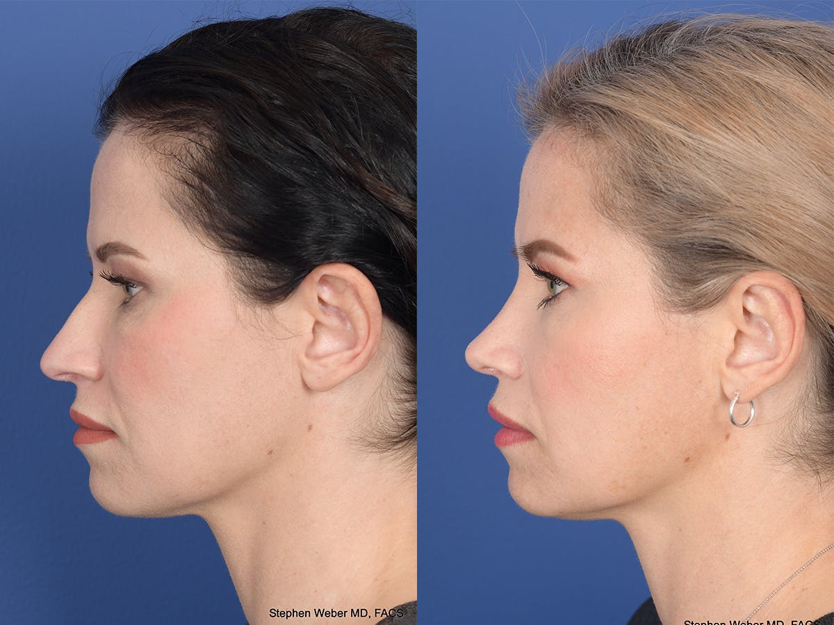 Rhinoplasty Before & After Gallery - Patient 677841 - Image 2