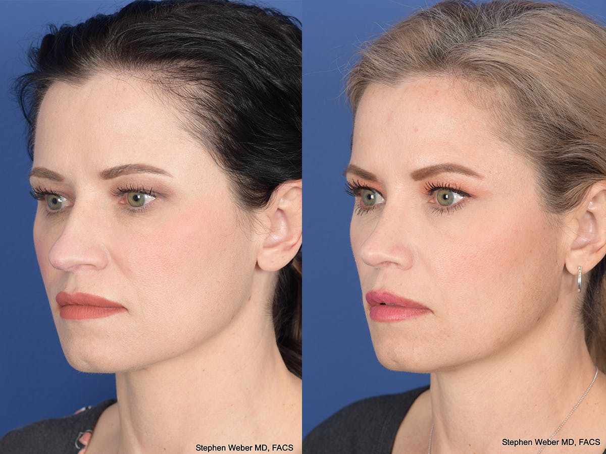 Rhinoplasty Before & After Gallery - Patient 677841 - Image 3