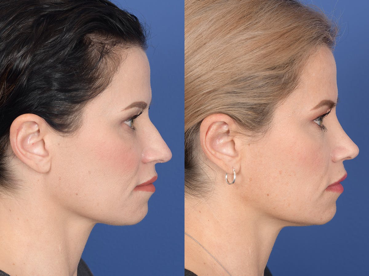 Rhinoplasty Before & After Gallery - Patient 677841 - Image 4