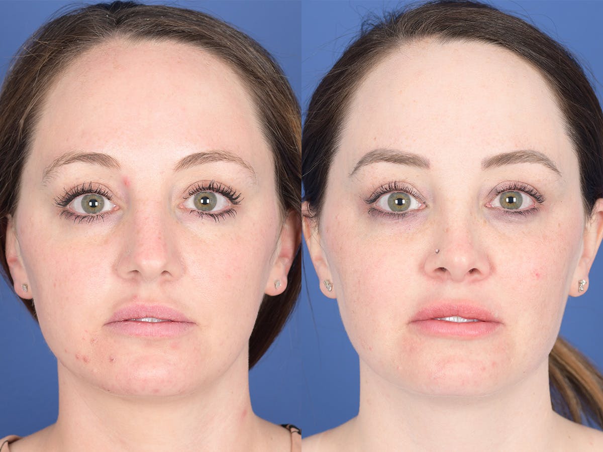 Rhinoplasty Before & After Gallery - Patient 203533 - Image 1