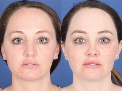Rhinoplasty Before & After Gallery - Patient 203533 - Image 1