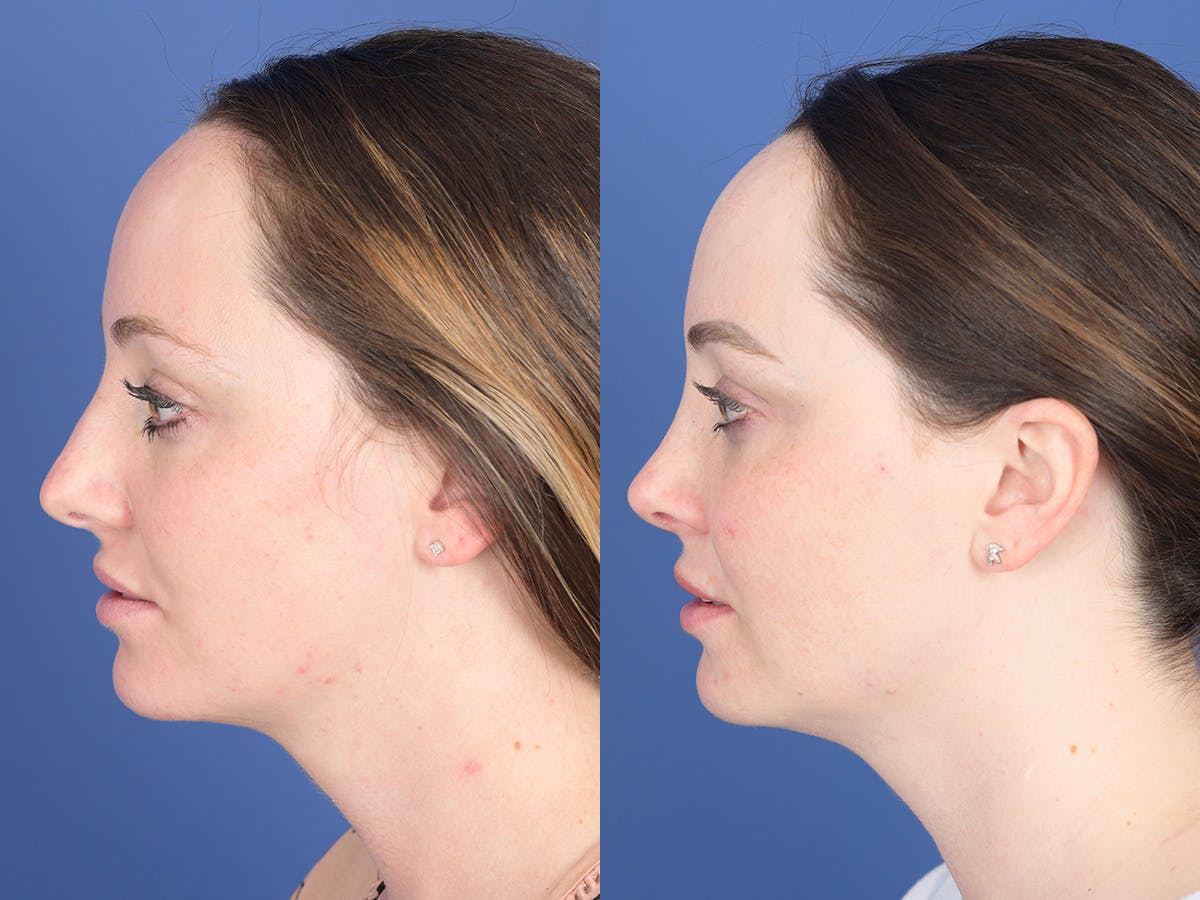 Rhinoplasty Before & After Gallery - Patient 203533 - Image 2