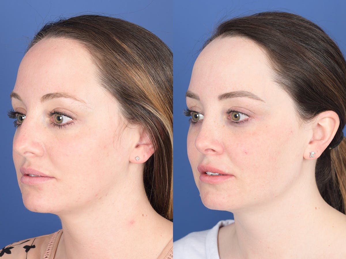 Rhinoplasty Before & After Gallery - Patient 203533 - Image 3