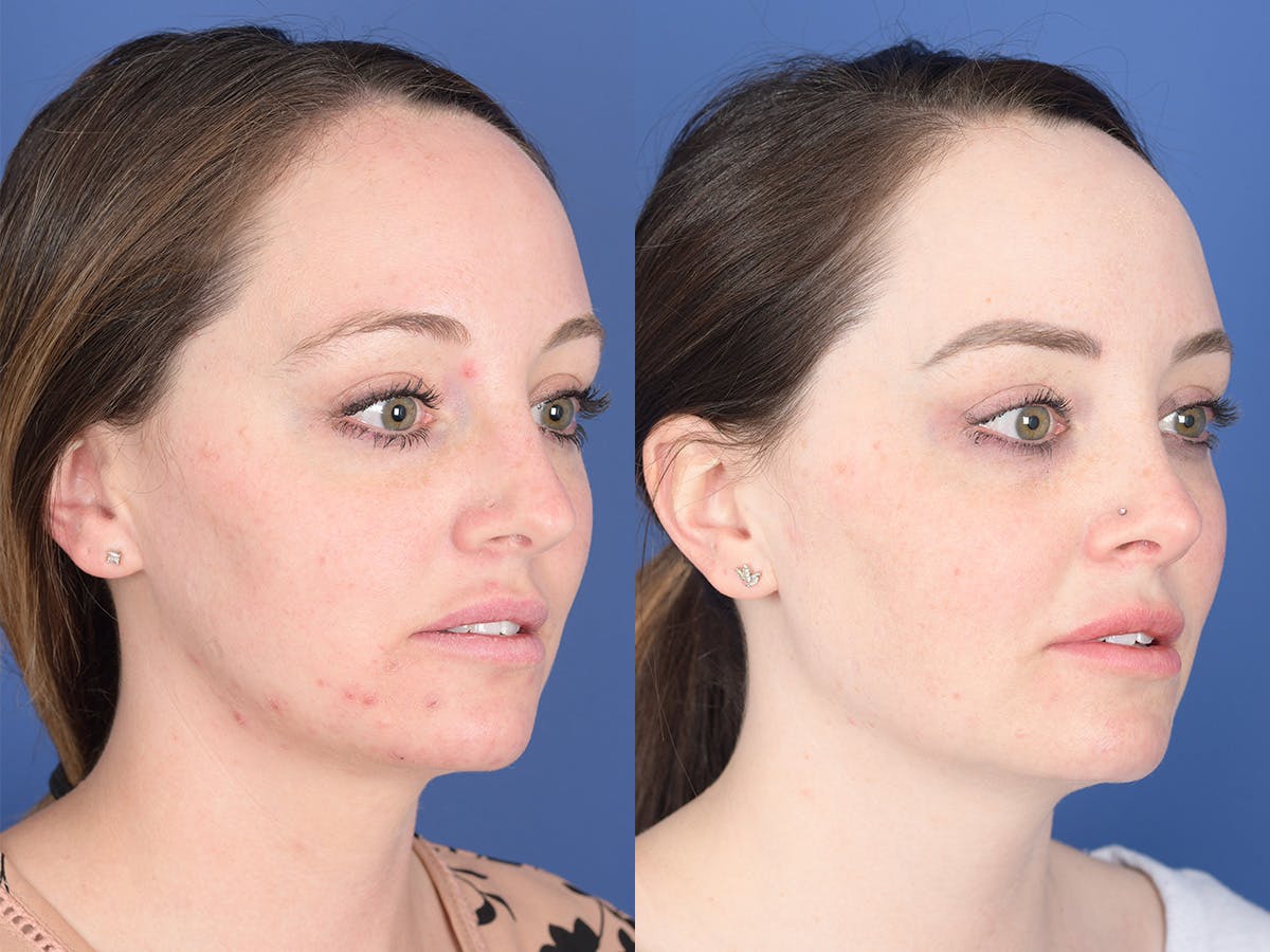 Rhinoplasty Before & After Gallery - Patient 203533 - Image 4