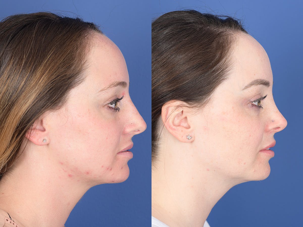 Rhinoplasty Before & After Gallery - Patient 203533 - Image 5