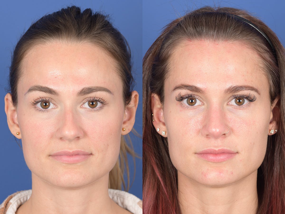 Rhinoplasty Before & After Gallery - Patient 274033 - Image 1