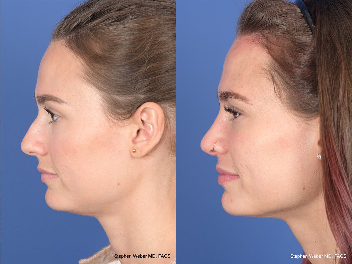 Rhinoplasty Before & After Gallery - Patient 274033 - Image 2