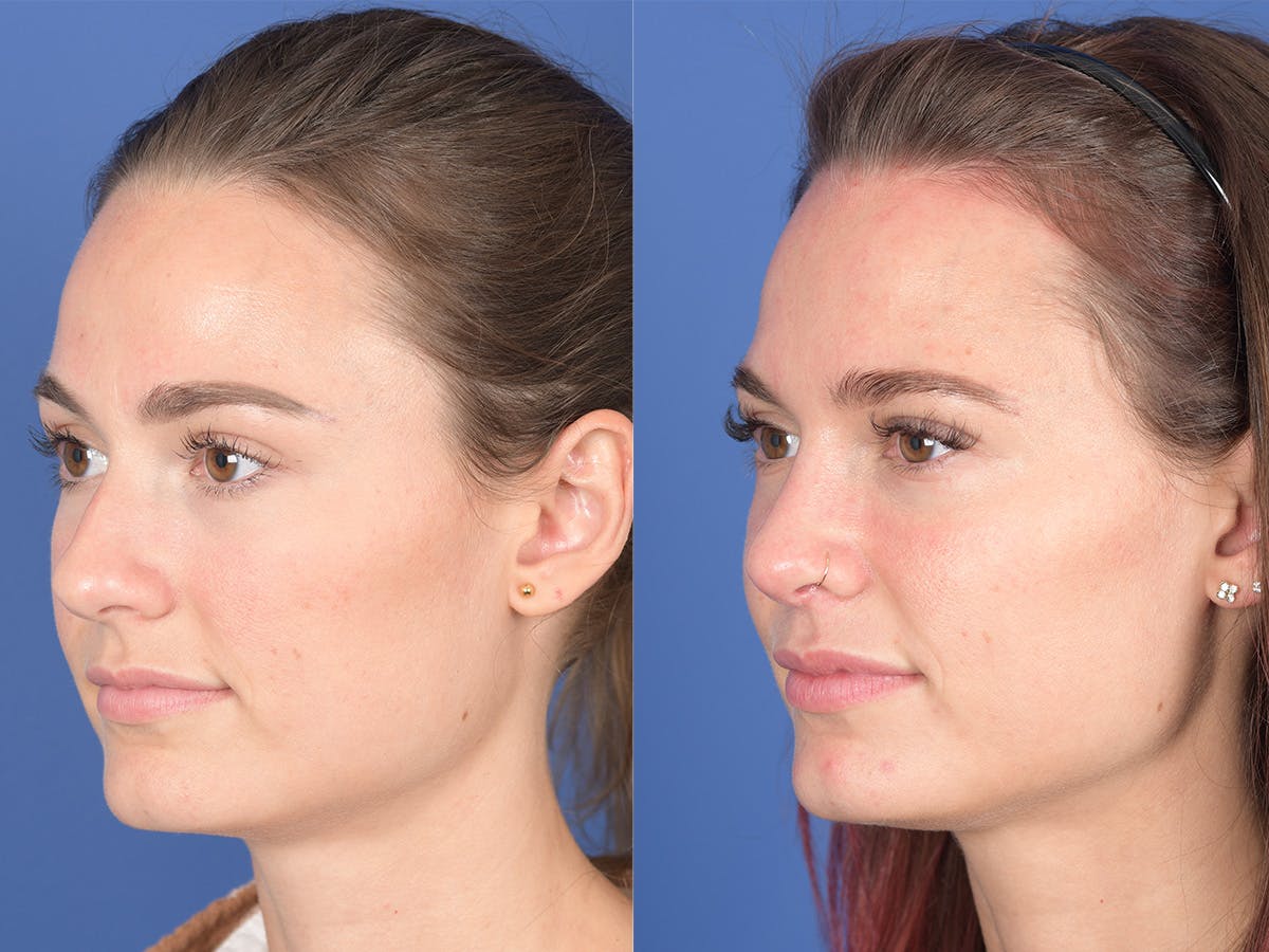 Rhinoplasty Before & After Gallery - Patient 274033 - Image 3