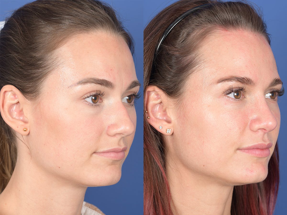 Rhinoplasty Before & After Gallery - Patient 274033 - Image 4
