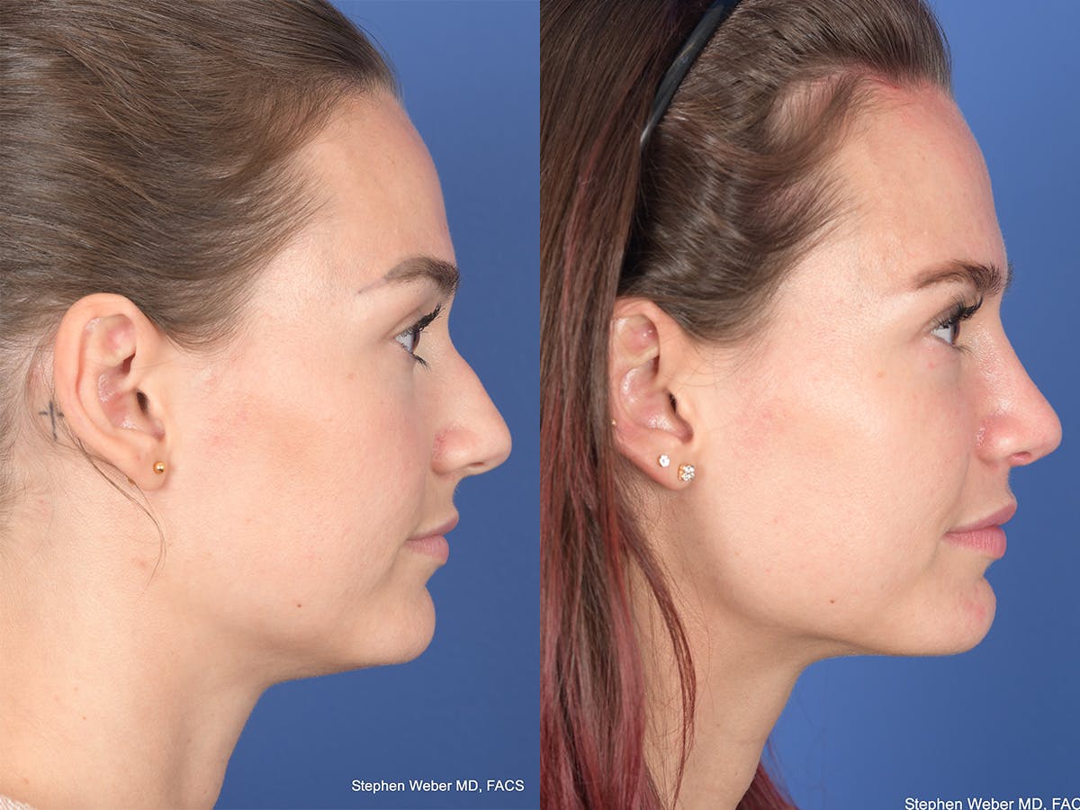 Rhinoplasty Before & After Gallery - Patient 274033 - Image 5