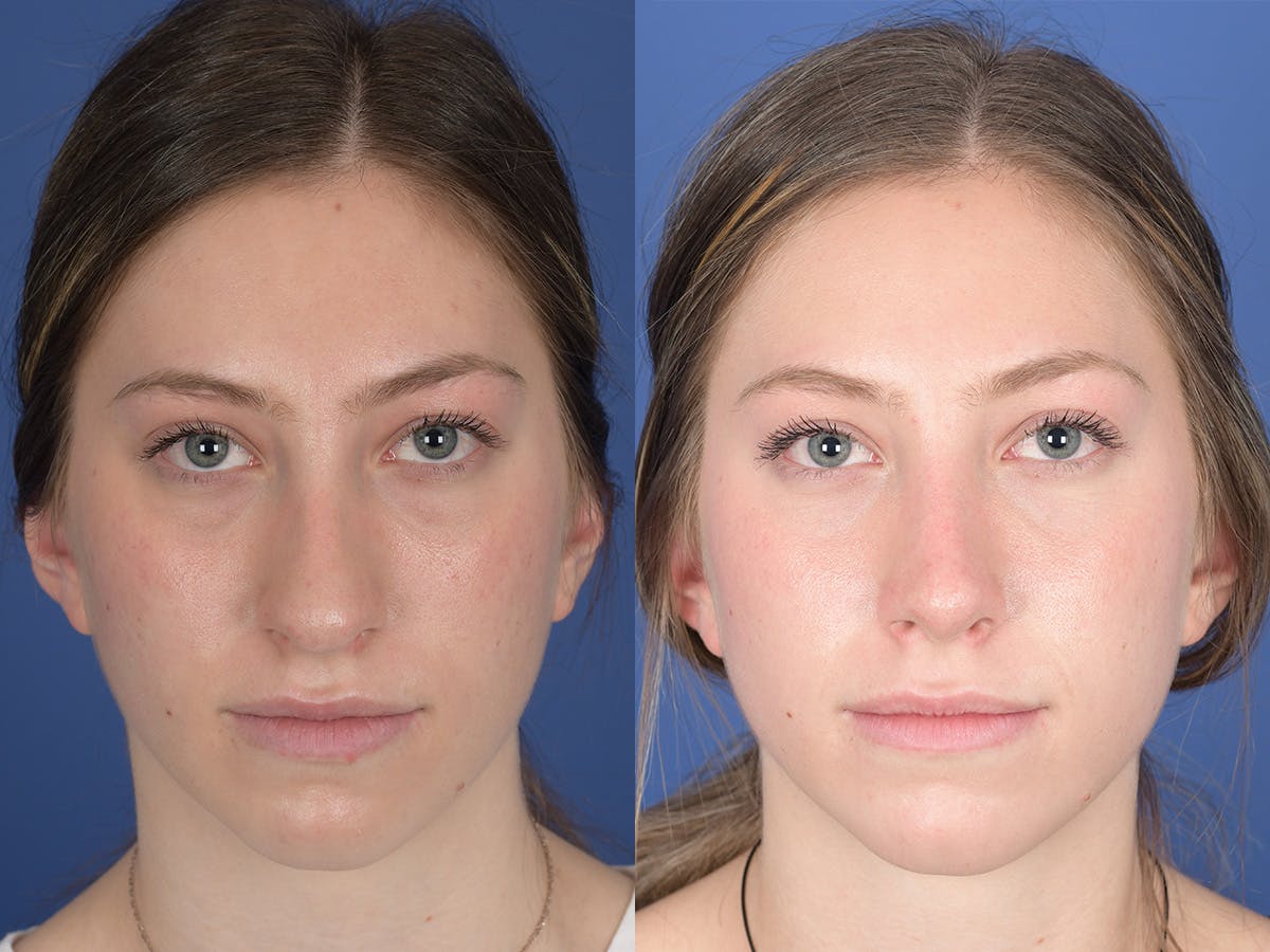 Rhinoplasty Before & After Gallery - Patient 351001 - Image 1