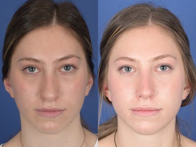 Rhinoplasty Before & After Gallery - Patient 351001 - Image 1
