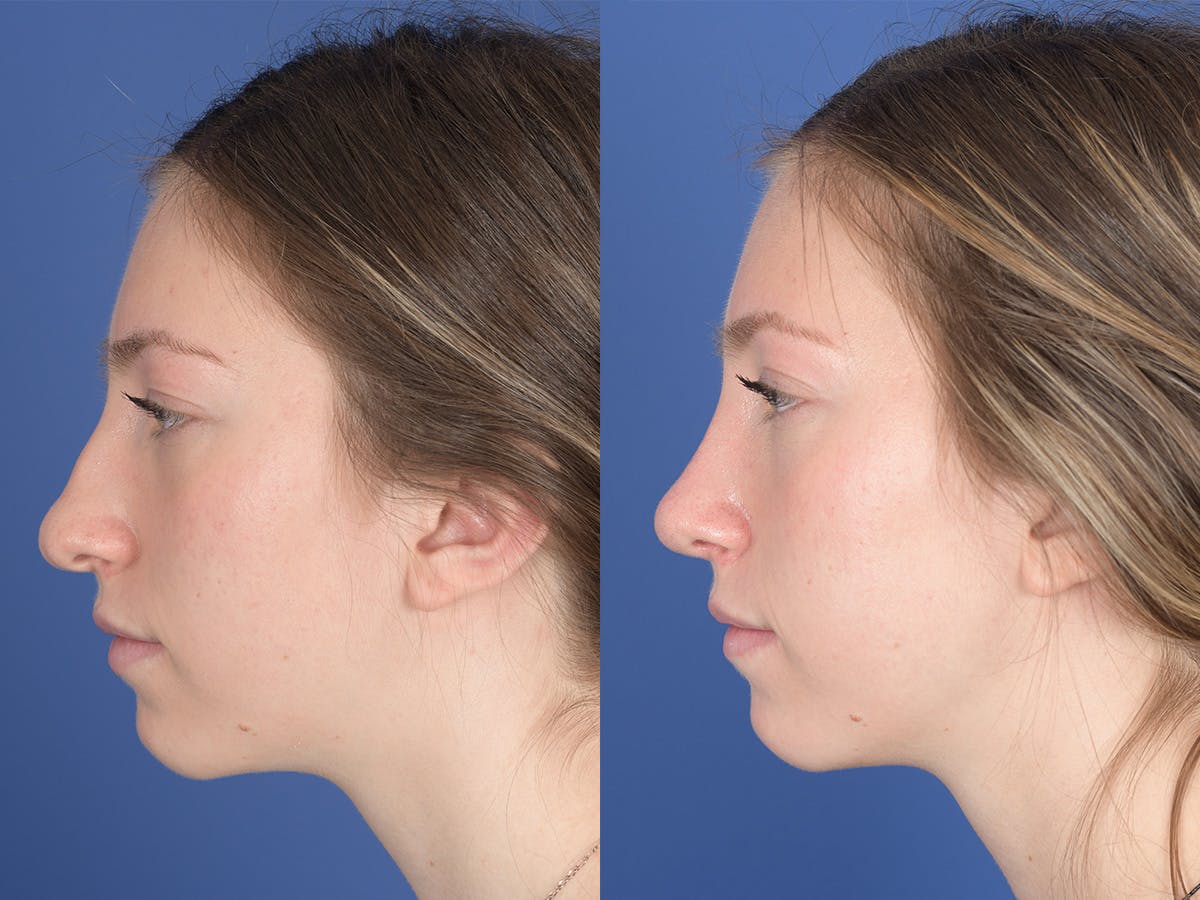 Rhinoplasty Before & After Gallery - Patient 351001 - Image 2