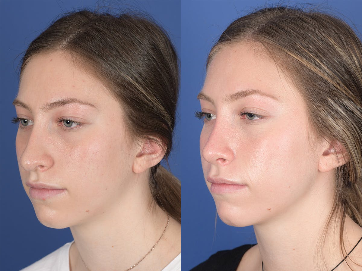 Rhinoplasty Before & After Gallery - Patient 351001 - Image 3