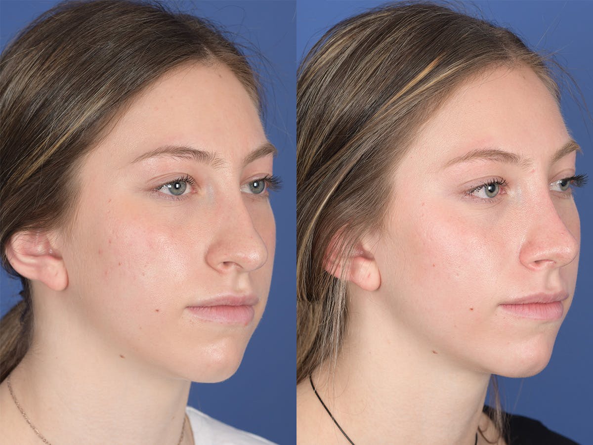 Rhinoplasty Before & After Gallery - Patient 351001 - Image 4