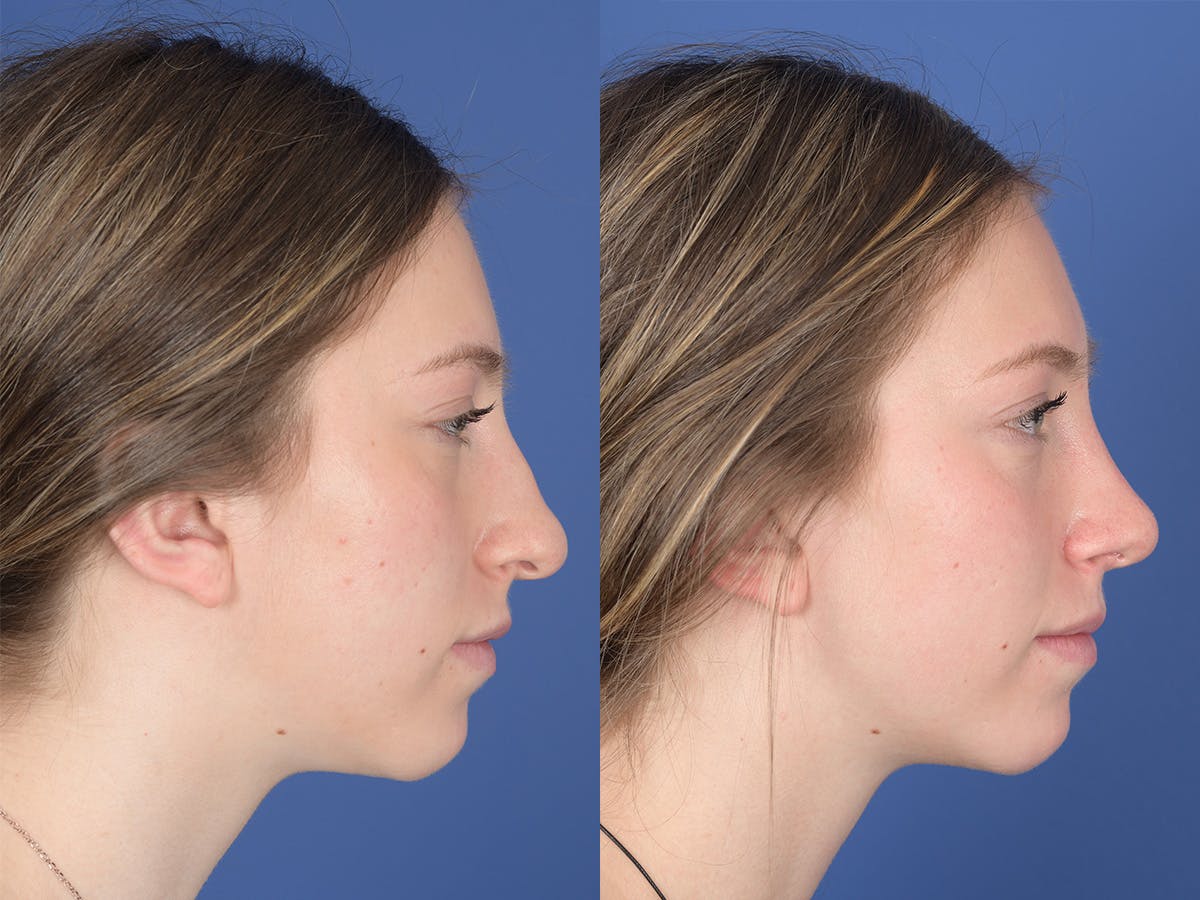Rhinoplasty Before & After Gallery - Patient 351001 - Image 5