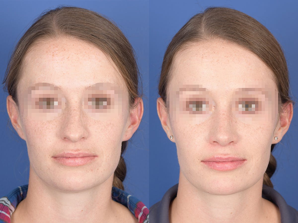 Rhinoplasty Before & After Gallery - Patient 156805 - Image 1
