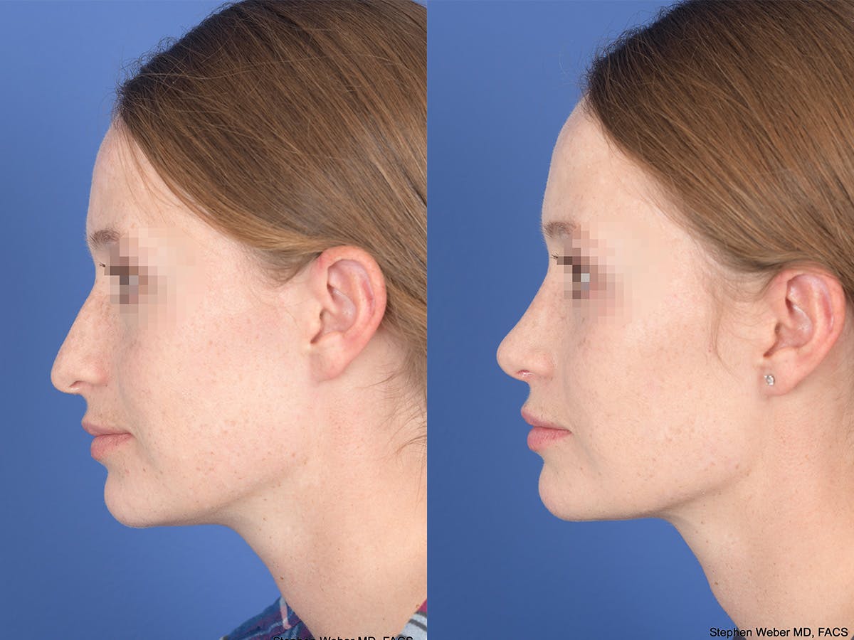 Rhinoplasty Before & After Gallery - Patient 156805 - Image 2