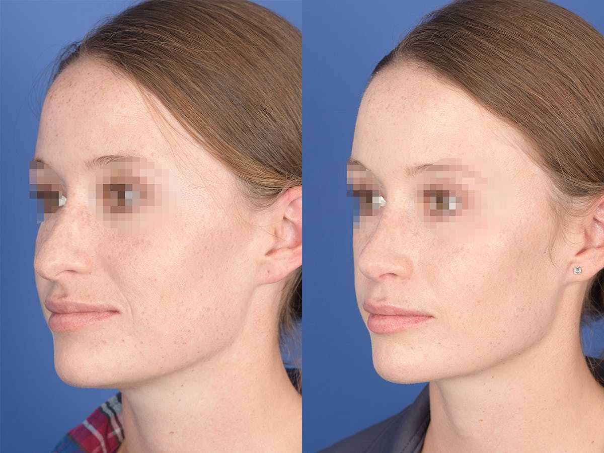 Rhinoplasty Before & After Gallery - Patient 156805 - Image 3