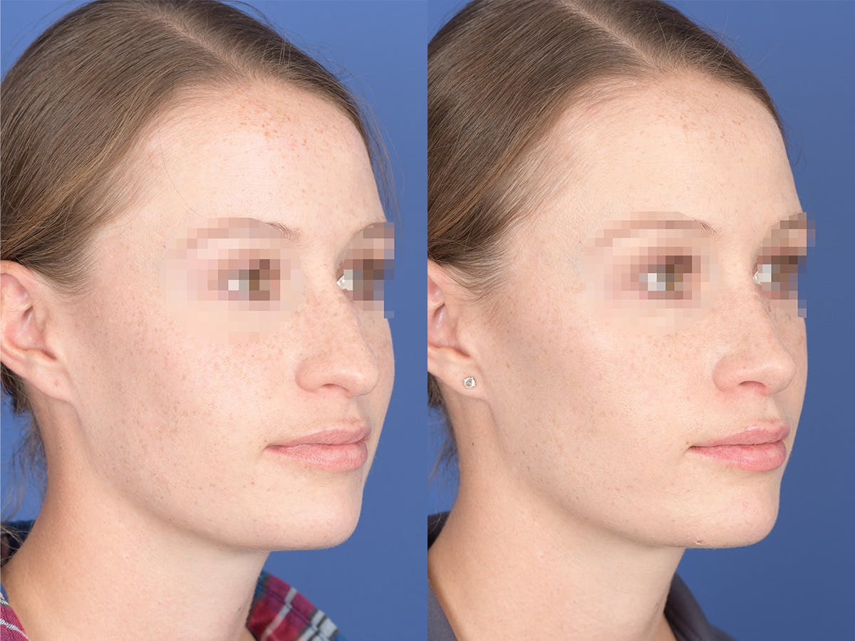 Rhinoplasty Before & After Gallery - Patient 156805 - Image 4