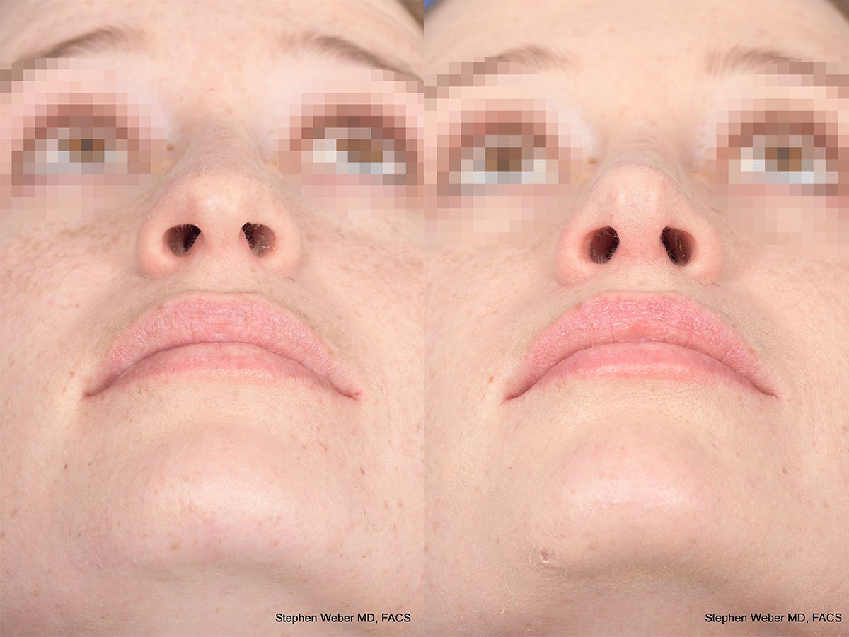 Rhinoplasty Before & After Gallery - Patient 156805 - Image 6