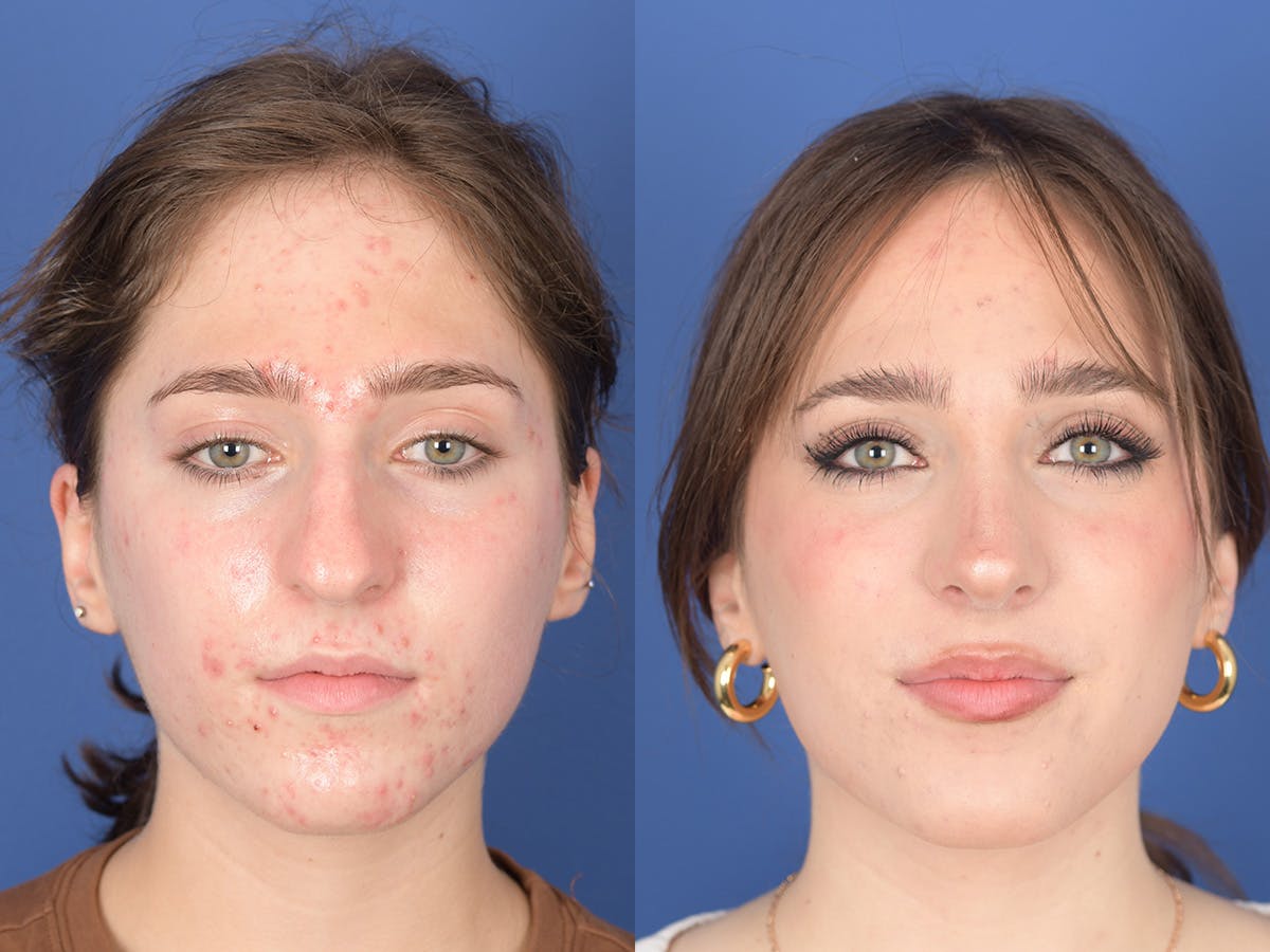 Rhinoplasty Before & After Gallery - Patient 254171 - Image 1