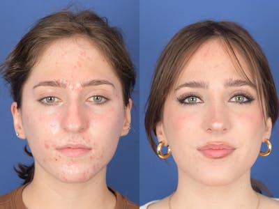 Rhinoplasty Before & After Gallery - Patient 254171 - Image 1