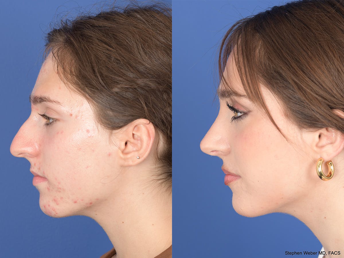 Rhinoplasty Before & After Gallery - Patient 254171 - Image 2