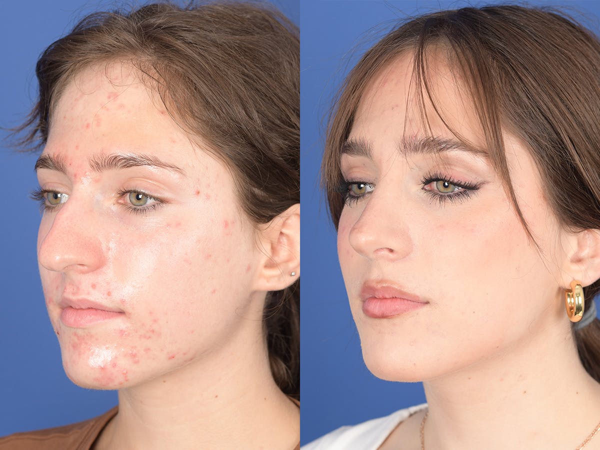 Rhinoplasty Before & After Gallery - Patient 254171 - Image 3