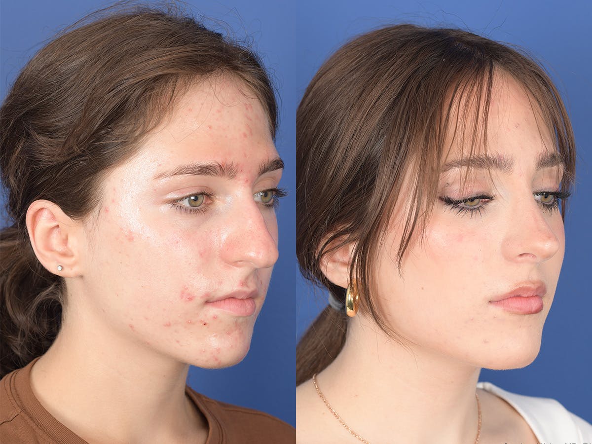Rhinoplasty Before & After Gallery - Patient 254171 - Image 4