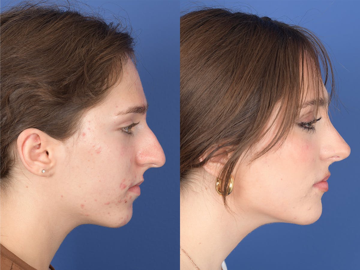 Rhinoplasty Before & After Gallery - Patient 254171 - Image 5