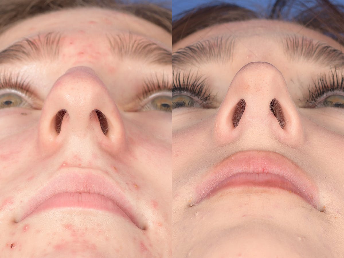 Rhinoplasty Before & After Gallery - Patient 254171 - Image 6