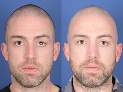 Rhinoplasty Before & After Gallery - Patient 418850 - Image 1