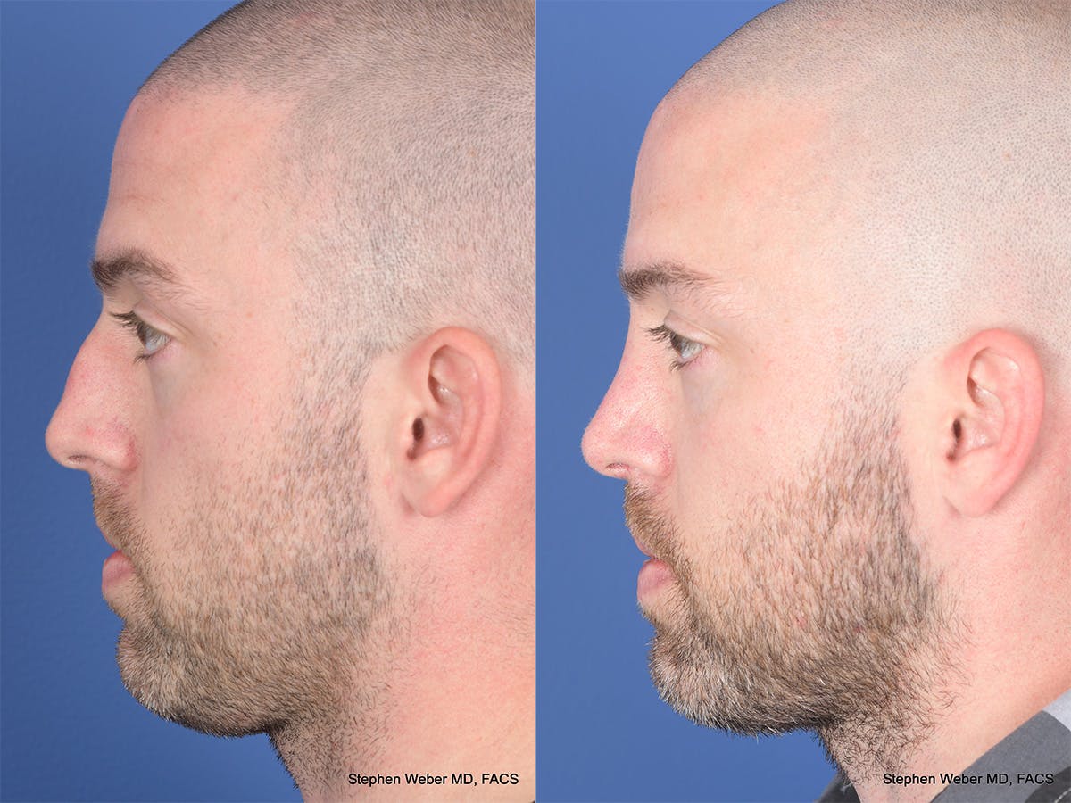 Rhinoplasty Before & After Gallery - Patient 418850 - Image 2