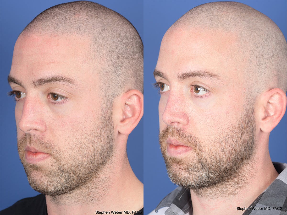 Rhinoplasty Before & After Gallery - Patient 418850 - Image 3