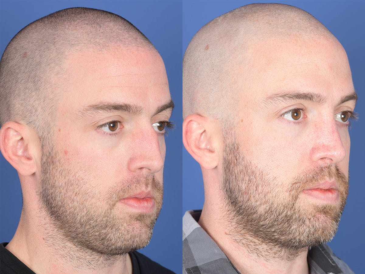 Rhinoplasty Before & After Gallery - Patient 418850 - Image 4