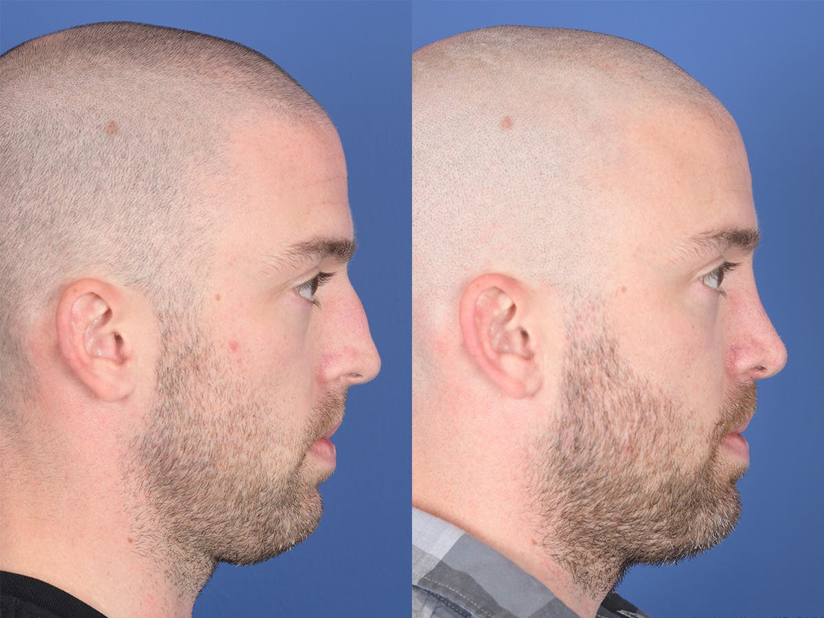 Rhinoplasty Before & After Gallery - Patient 418850 - Image 5