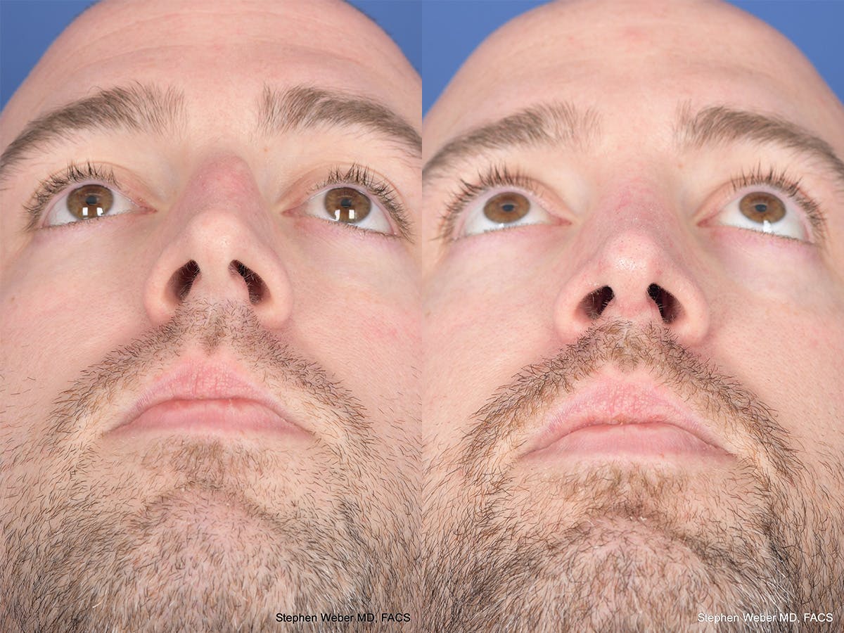 Rhinoplasty Before & After Gallery - Patient 418850 - Image 6