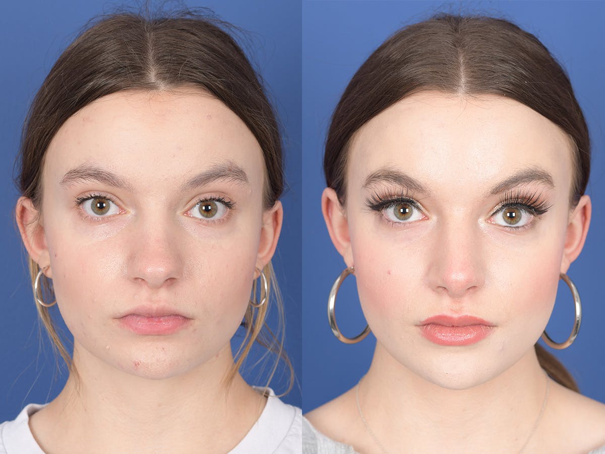 Rhinoplasty Before & After Gallery - Patient 371814 - Image 1