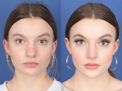 Rhinoplasty Before & After Gallery - Patient 371814 - Image 1