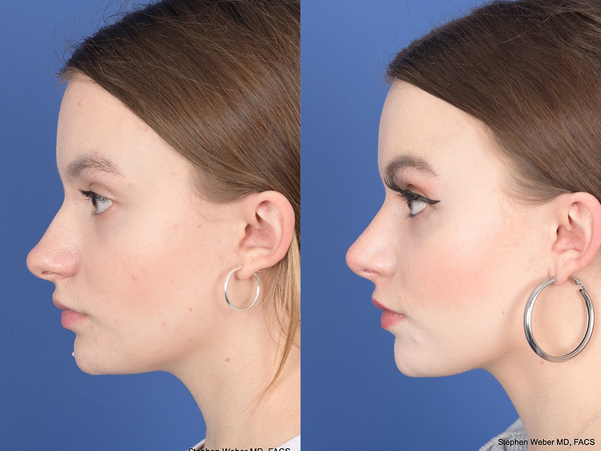 Rhinoplasty Before & After Gallery - Patient 371814 - Image 2