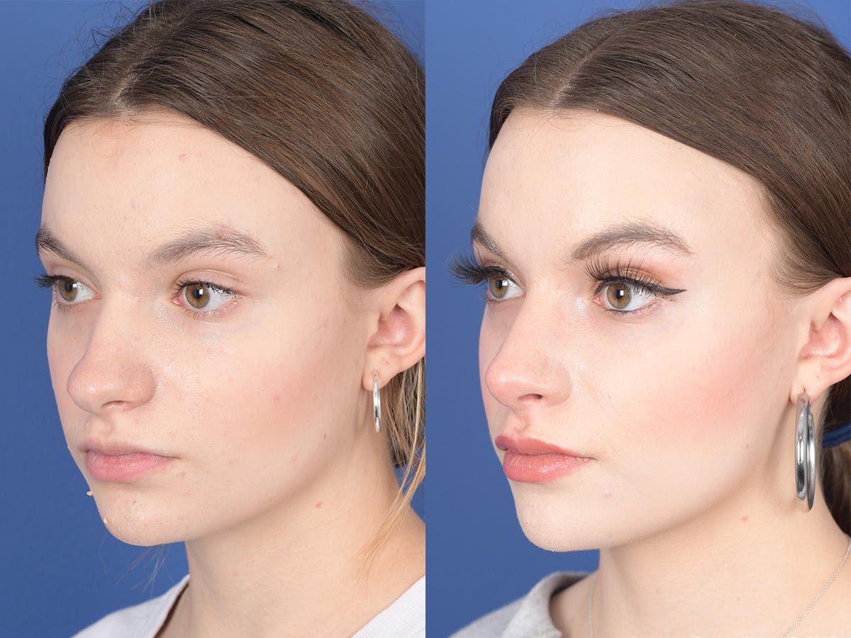 Rhinoplasty Before & After Gallery - Patient 371814 - Image 3