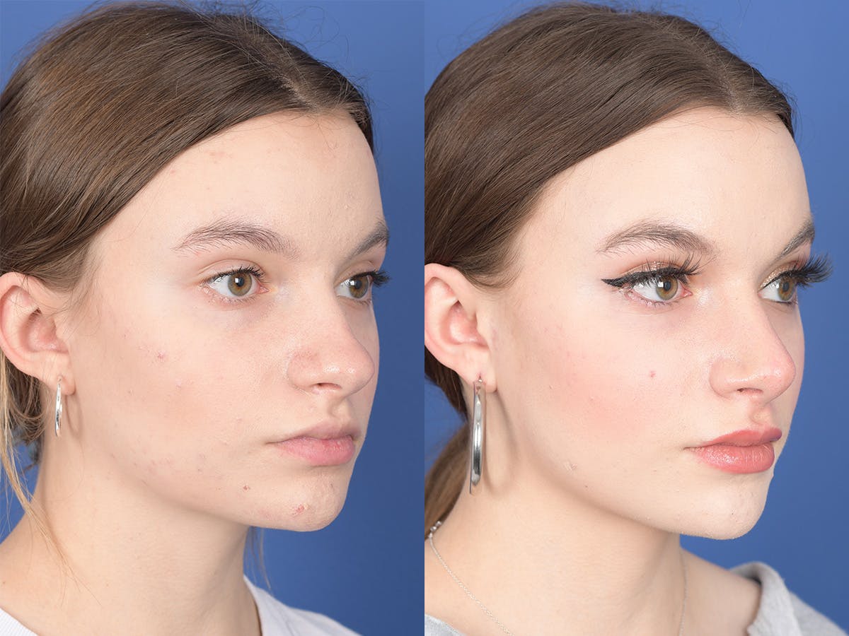 Rhinoplasty Before & After Gallery - Patient 371814 - Image 4