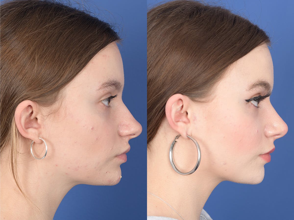 Rhinoplasty Before & After Gallery - Patient 371814 - Image 5