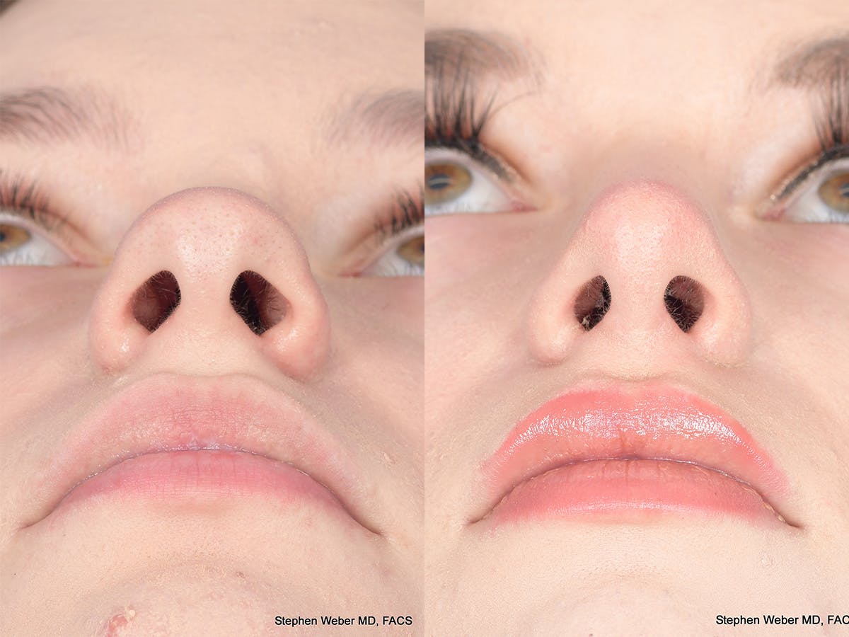 Rhinoplasty Before & After Gallery - Patient 371814 - Image 6