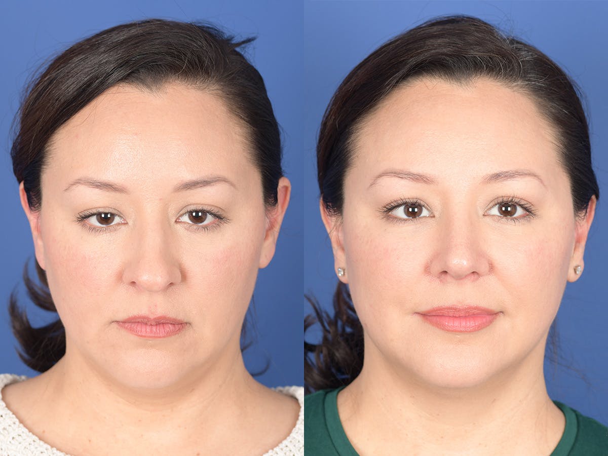 Rhinoplasty Before & After Gallery - Patient 391234 - Image 1