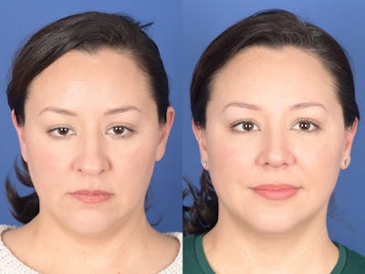 Rhinoplasty Before & After Gallery - Patient 391234 - Image 1