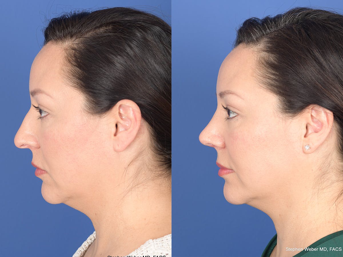 Rhinoplasty Before & After Gallery - Patient 391234 - Image 2